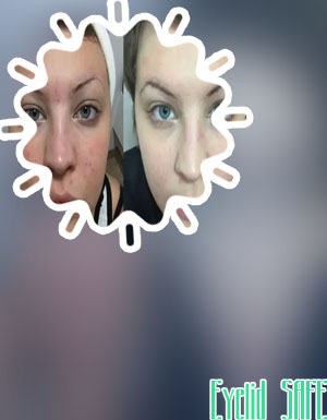 Neora eye patches before and after